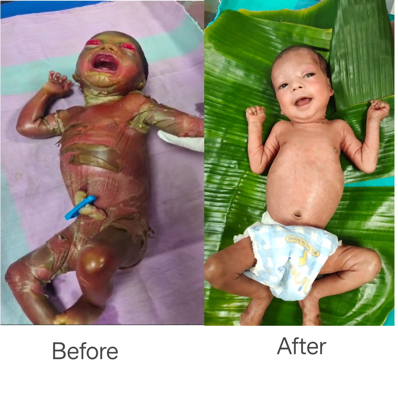 सुदूर बीजापुर में चिकित्सा चमत्कार : अत्यंत दुर्लभ बीमारी से जूझते शिशु को बचाया….